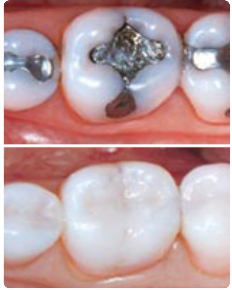White fillings